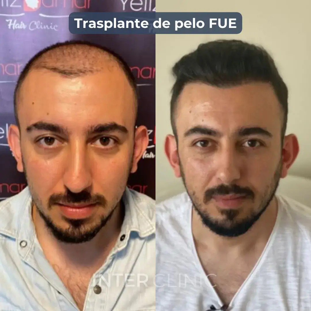 trasplante-de-cabello-fue