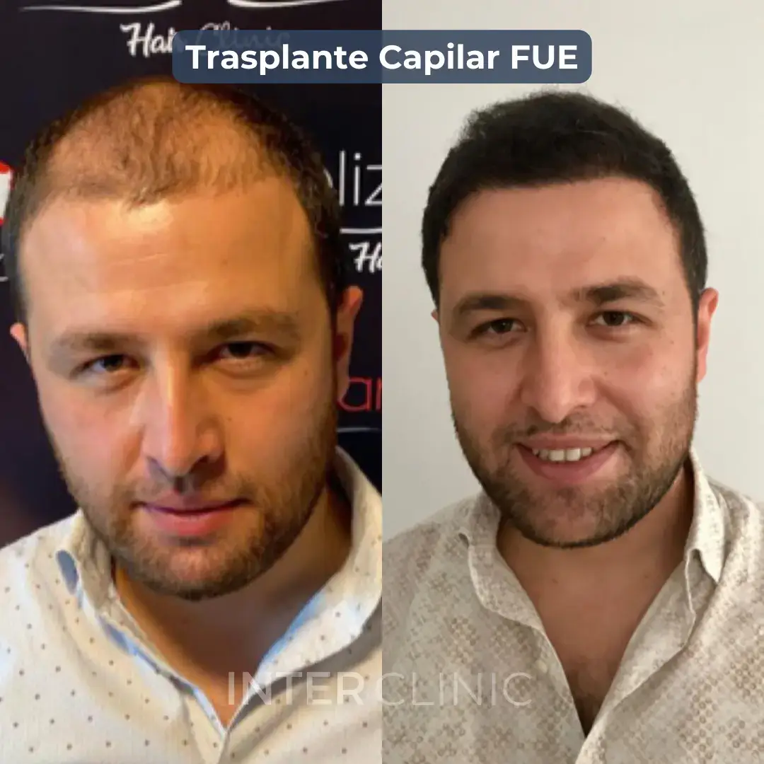 trasplante-capilar-fue-turquia