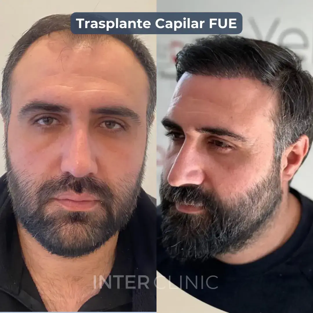 trasplante-fue-turquia