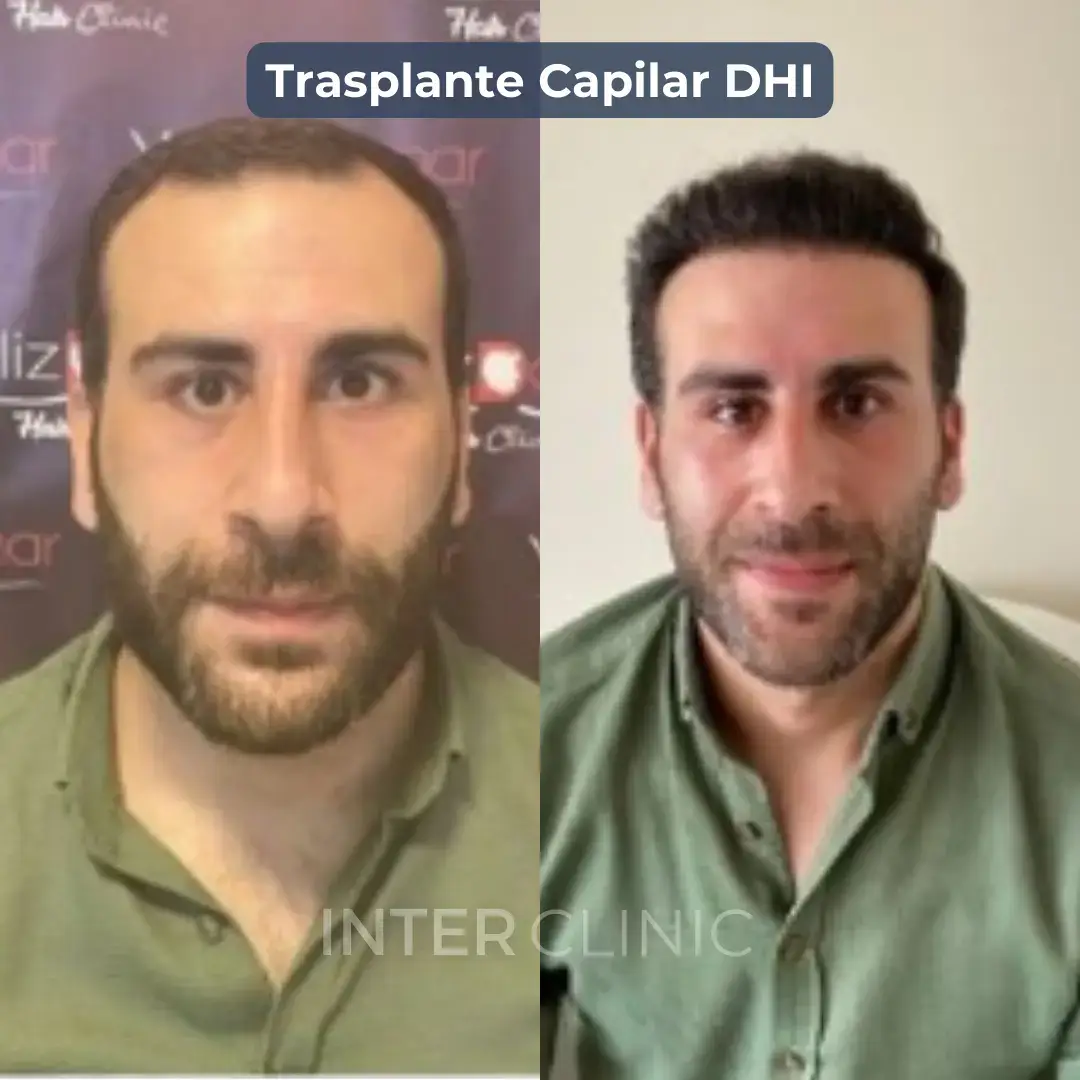 trasplante-de-pelo-dhi