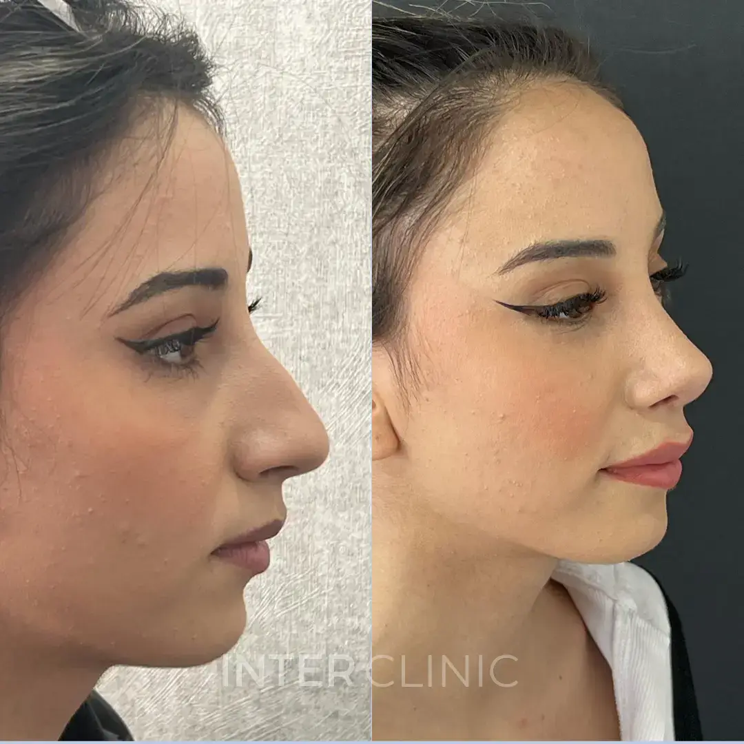 rinoplastia-en-turquia