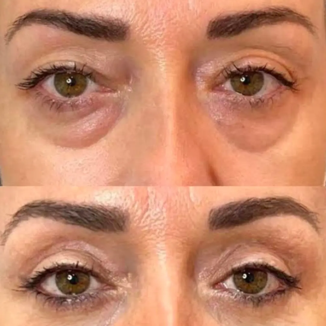 blefaroplastia-resultados