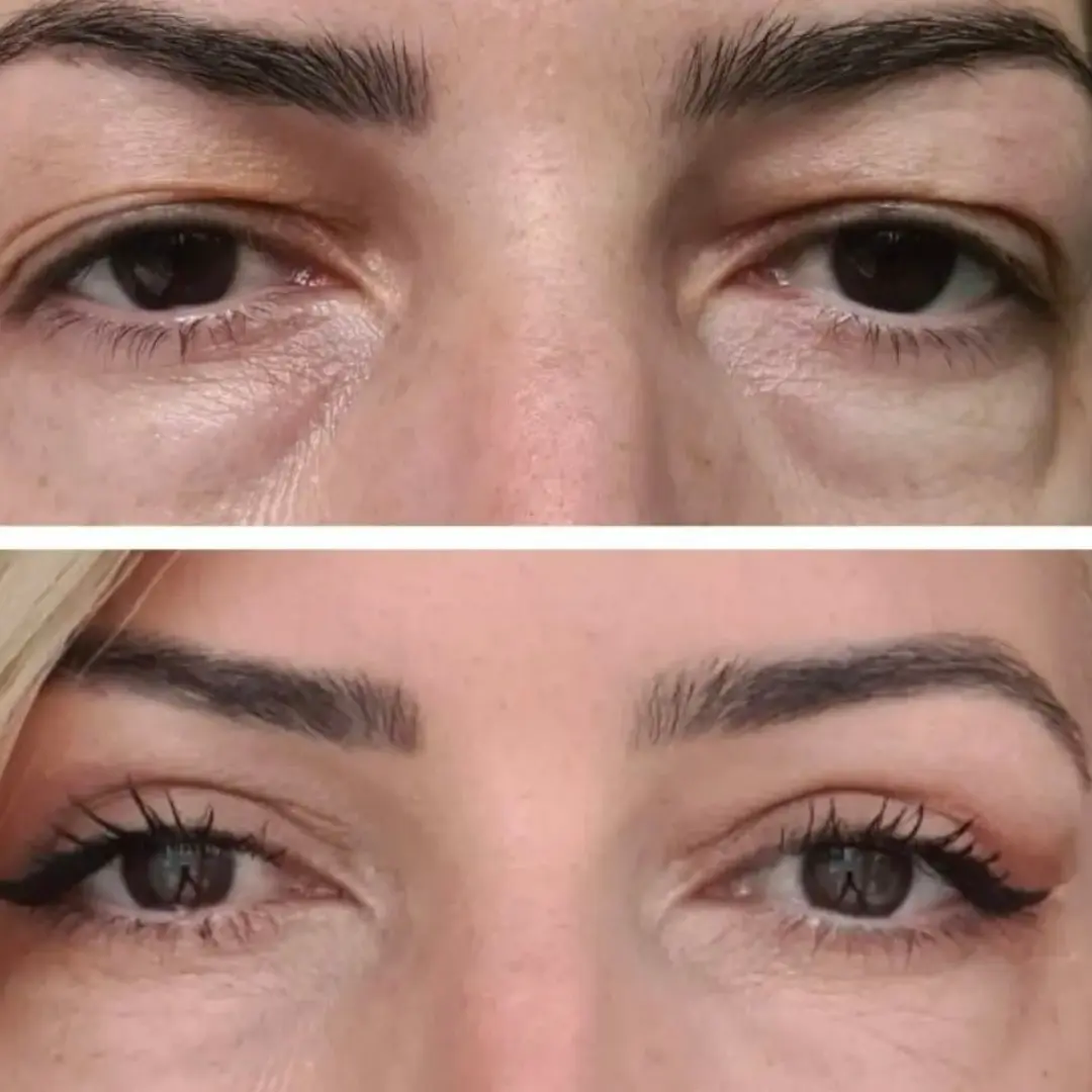 blefaroplastia-cirugía-de-párpados