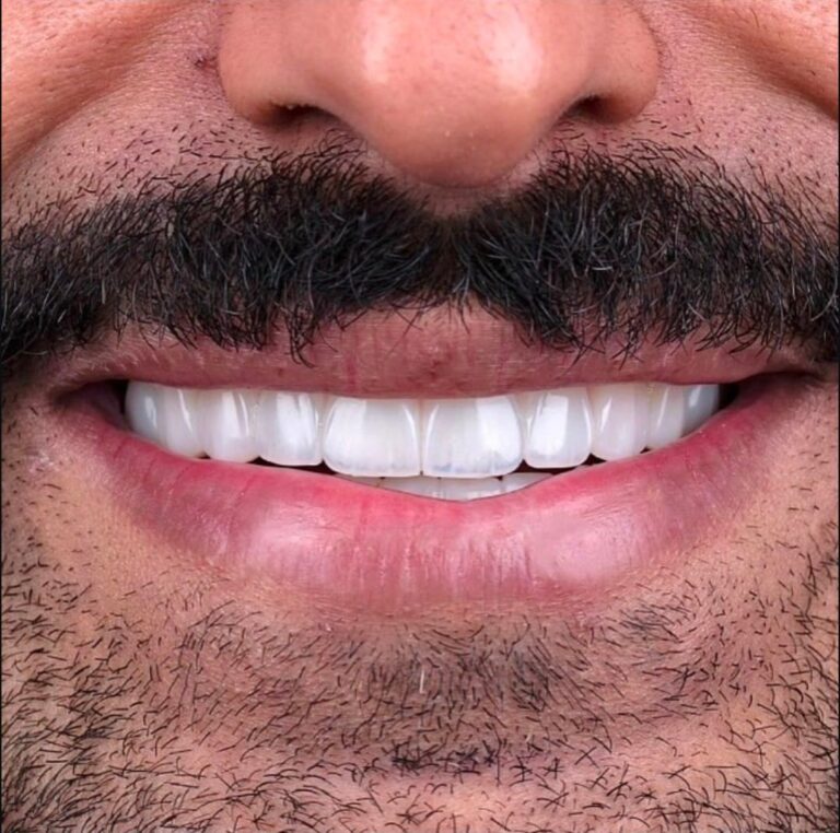 carillas dentales son para siempre