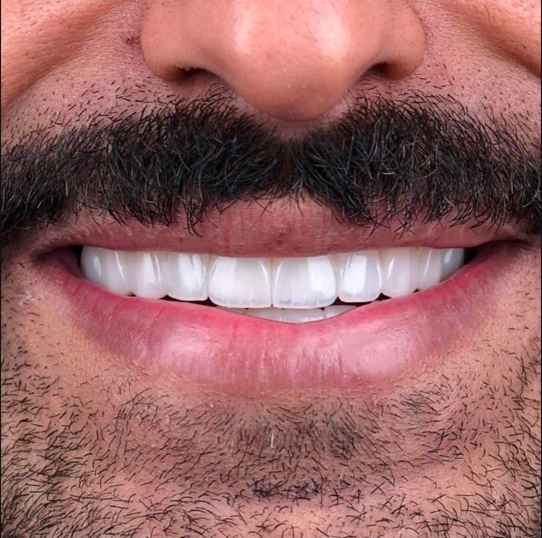 carillas dentales son para siempre