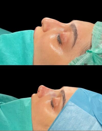 Rinoplastia-ultrasonica