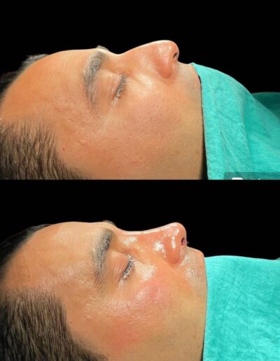 Antes-y-Después-Rinoplastia-Ultrasonica