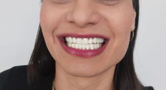 antes y después carillas de porcelana
