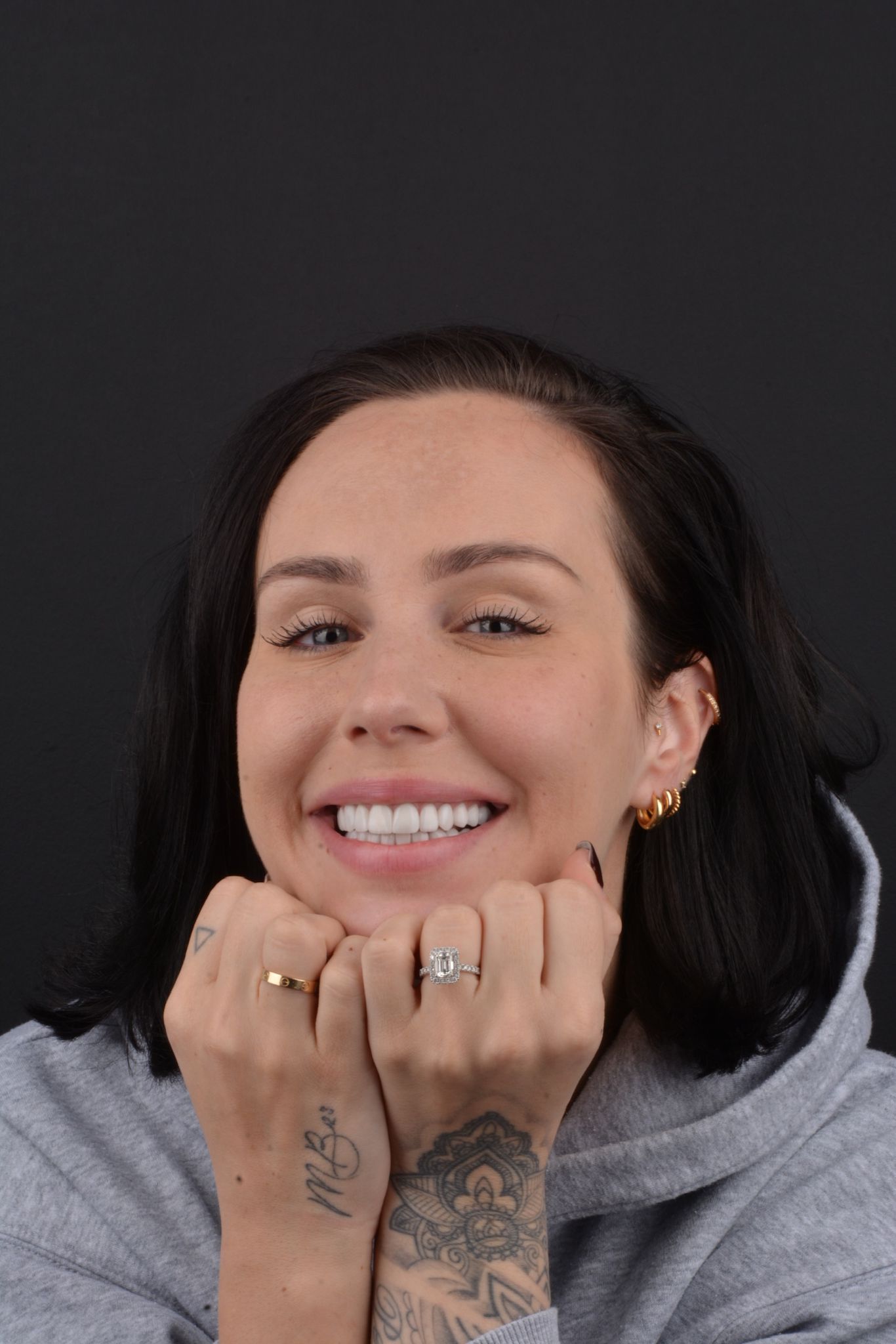 clínica-dental-en-turquía-resultados-interclinic3