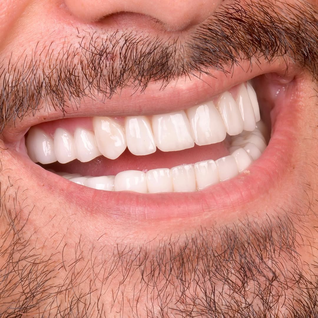 carillas dentales en turquía