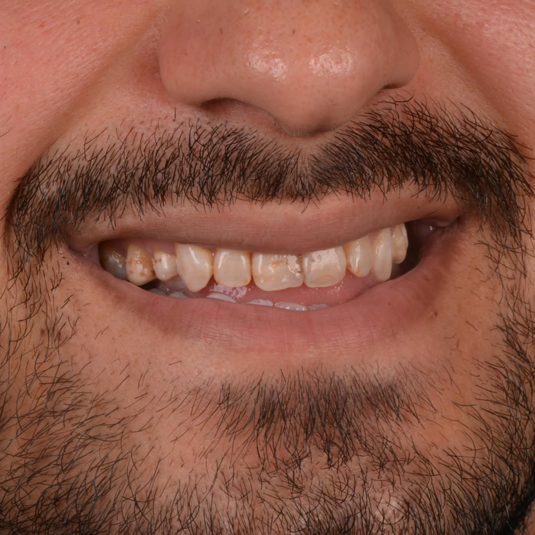 carillas dentales en turquía