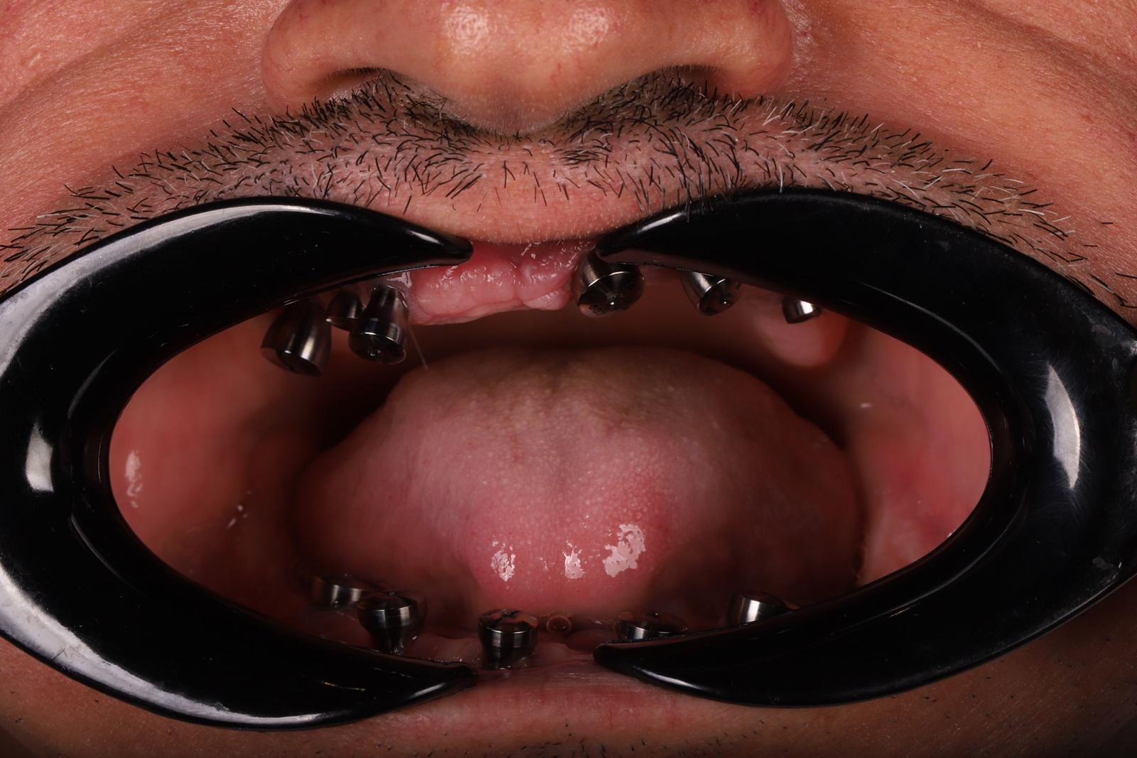 tratamiento-all-on-four-antes