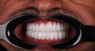 tiempo-entre-extracción-e-implante-dental