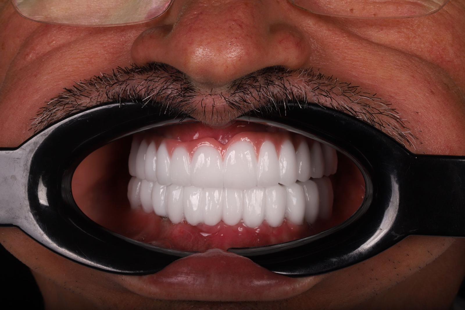 ¿Tiempo entre extracción e implante dental? Te lo detallamos